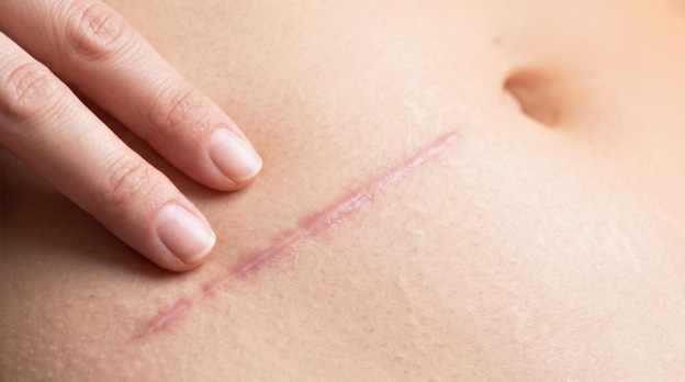 A close-up of a person's abdomen showing a healed surgical scar with a person's hand gently touching it.