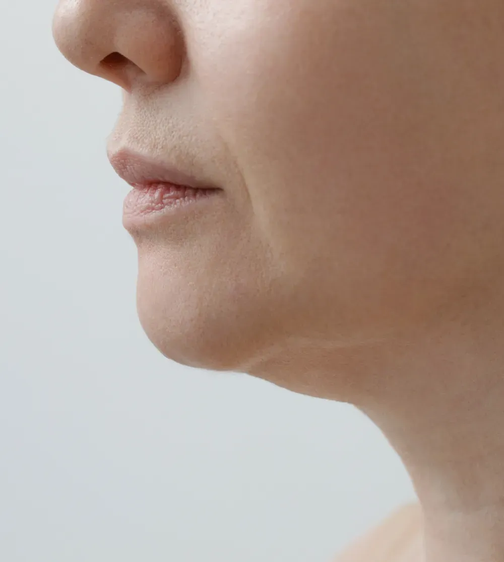 Facelift treatment photo