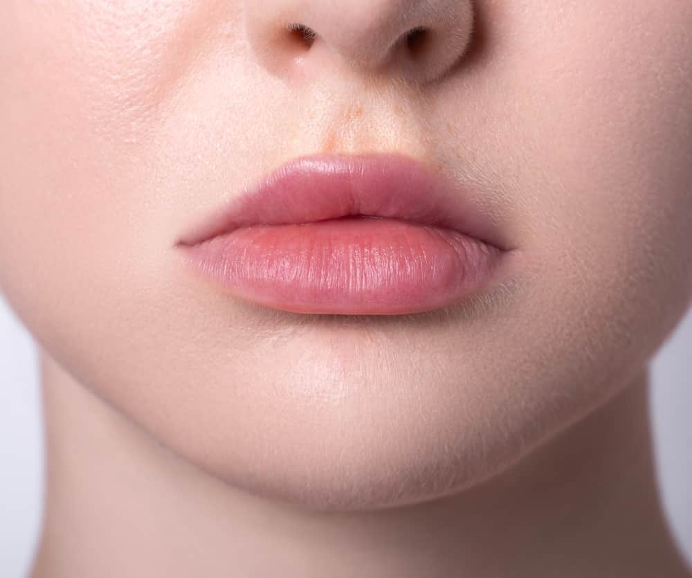 How to reduce bruising after lip fillers?
