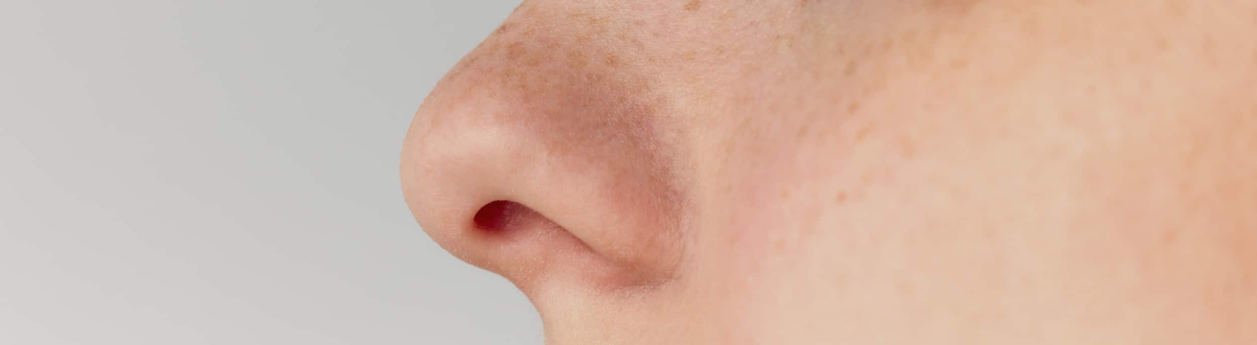 Rhinoplasty swelling stages