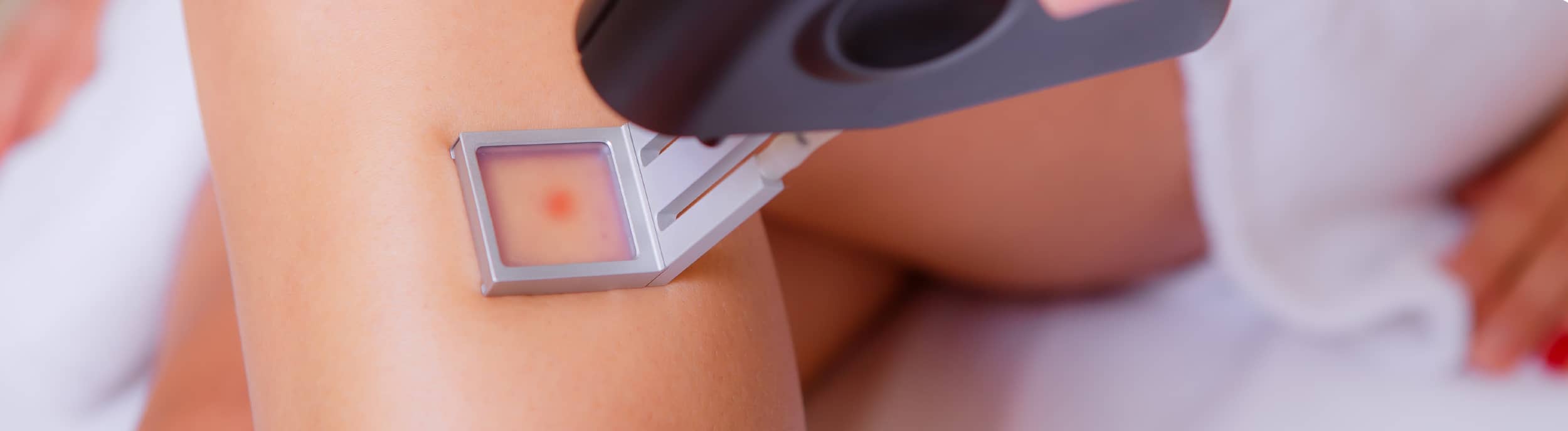 Laser hair removal – how long does it last?