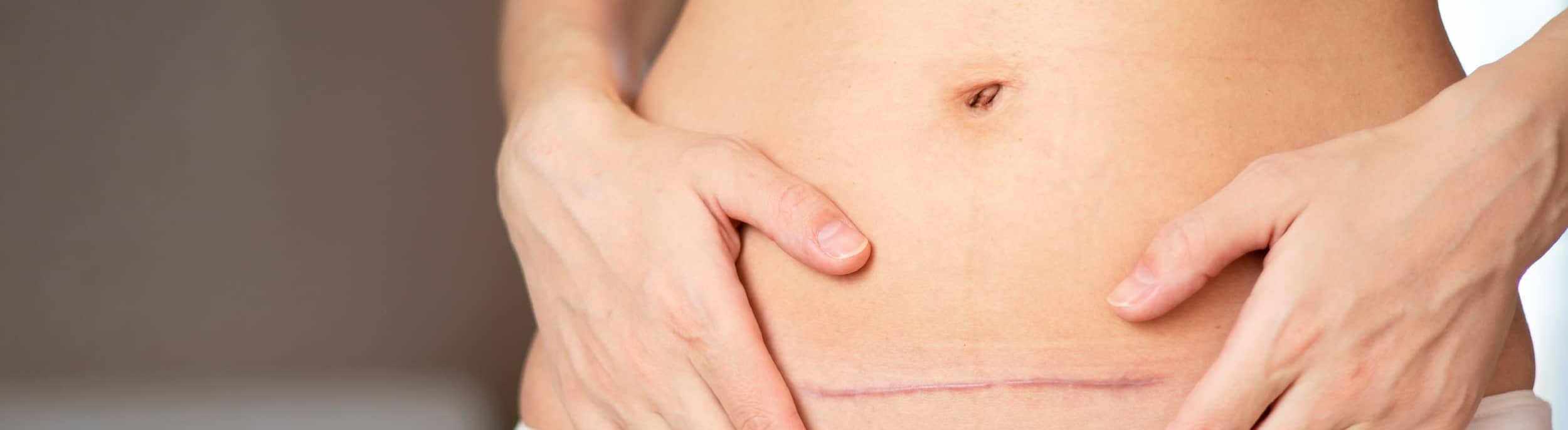Mummy makeover risks and considerations