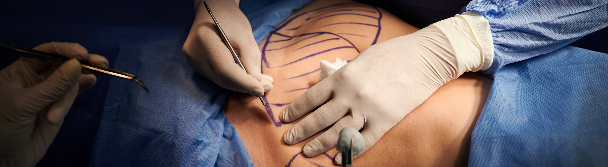 How long does it take to recover from liposuction?