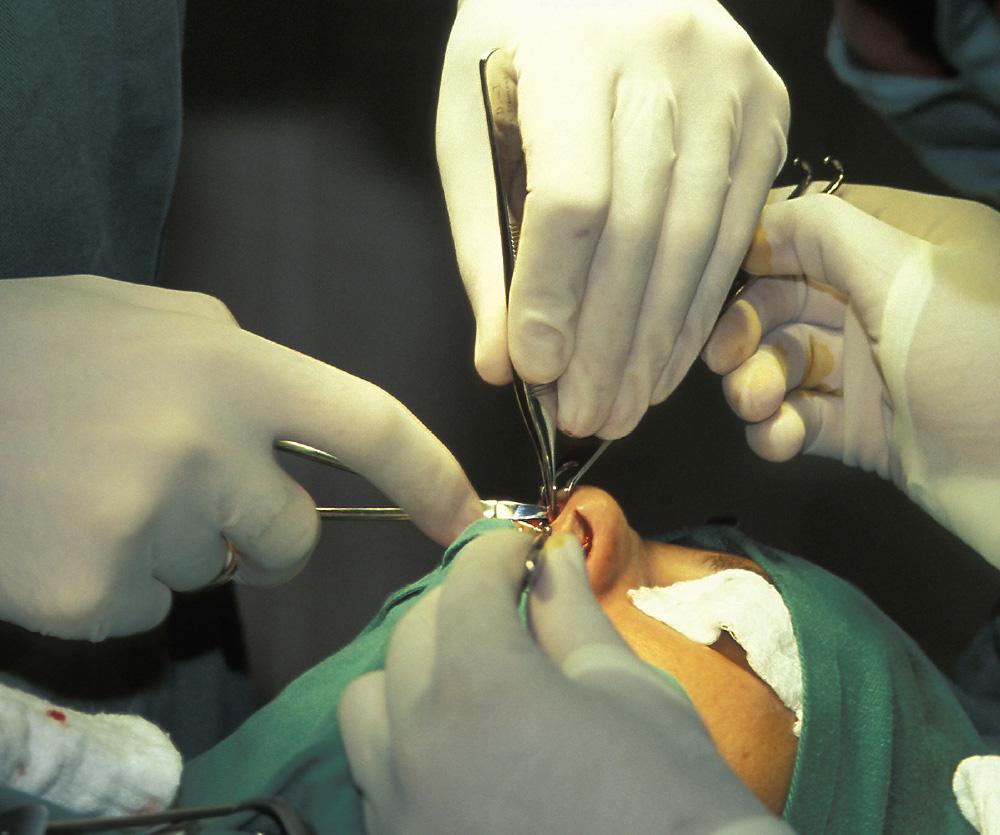 Nose blocked after septoplasty