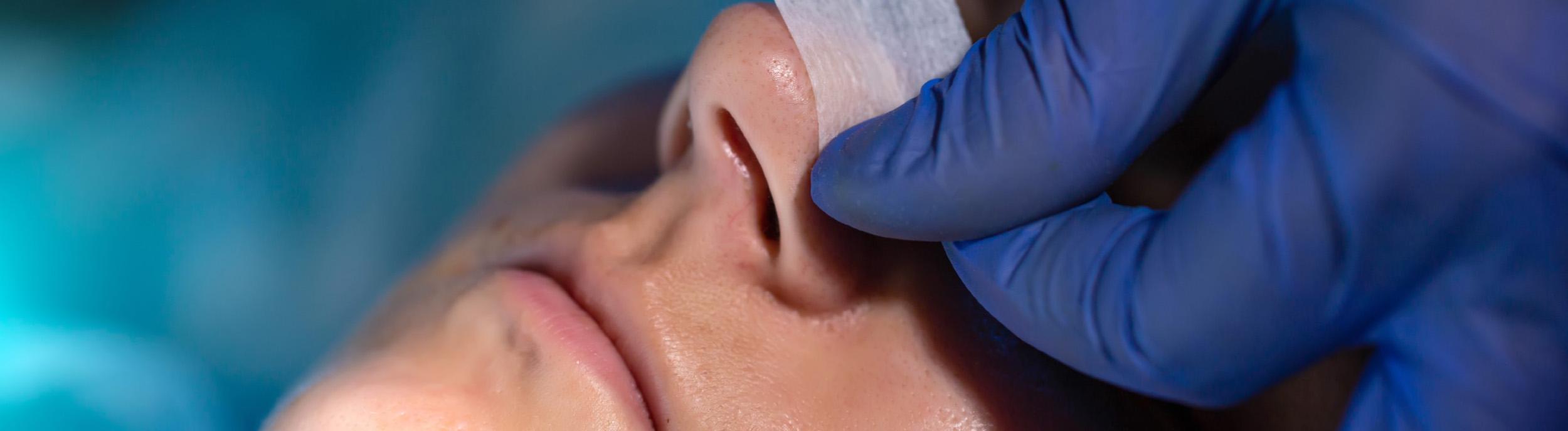 What is septoplasty splint?
