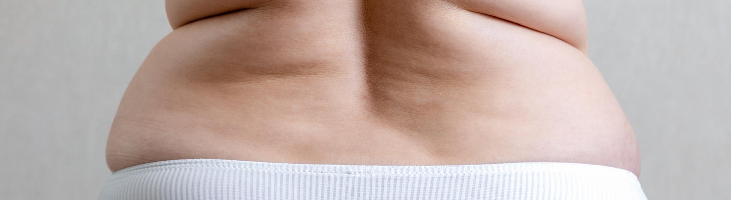 How to lose weight without excess skin