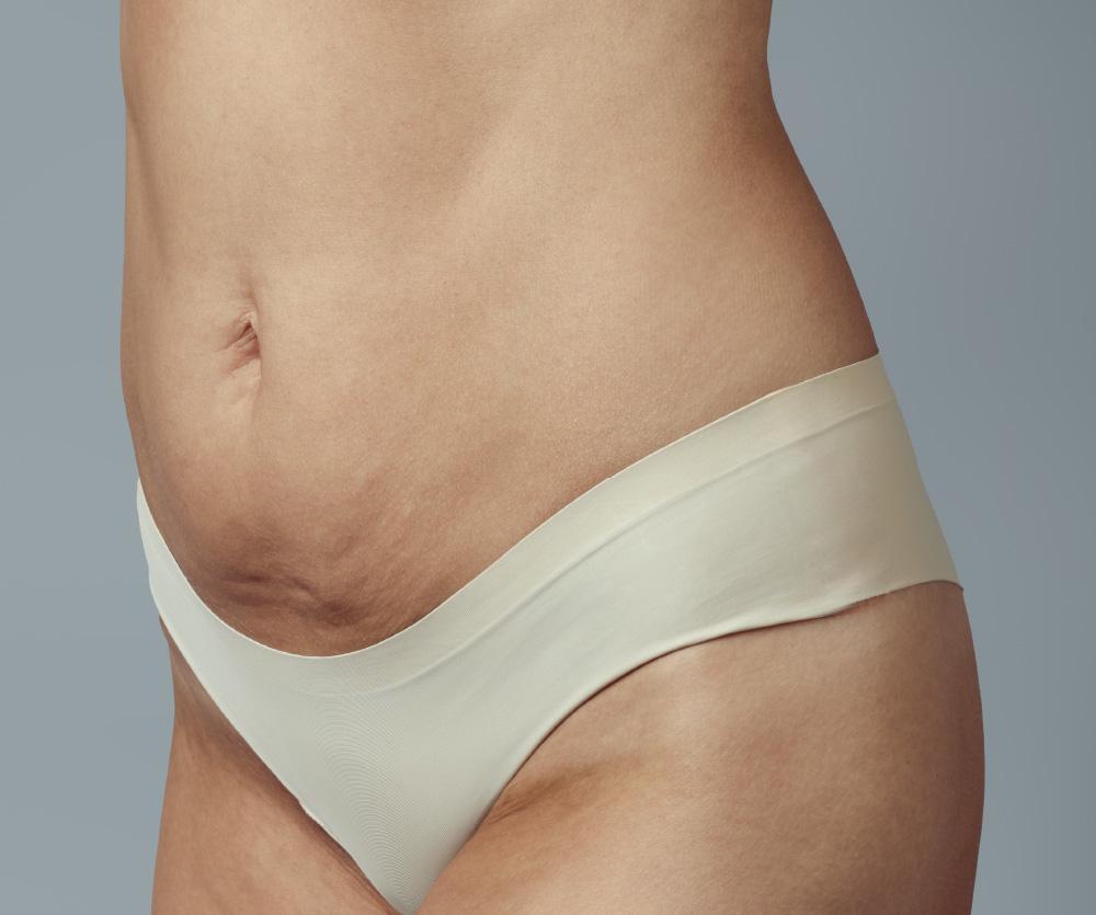 Does excess skin go away?
