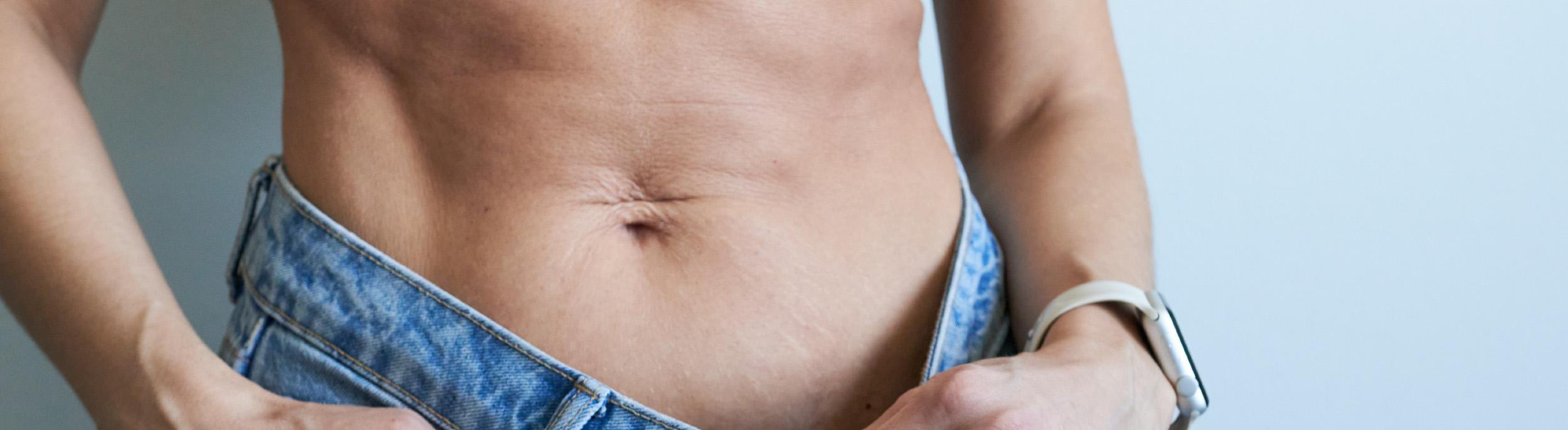 Does excess skin go away?