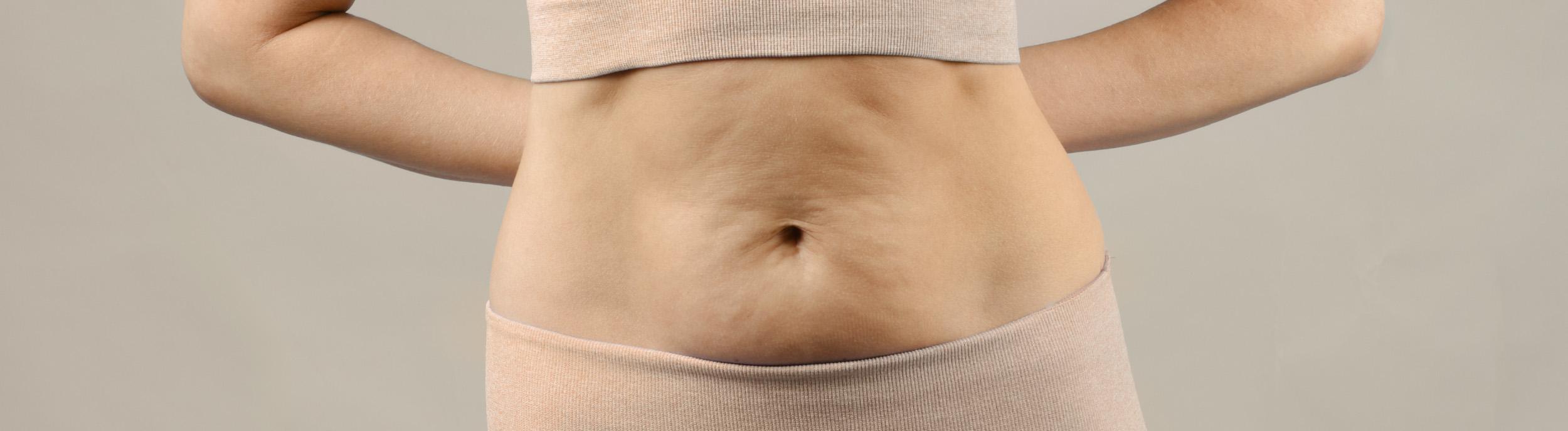 What happens to excess skin when you lose weight?
