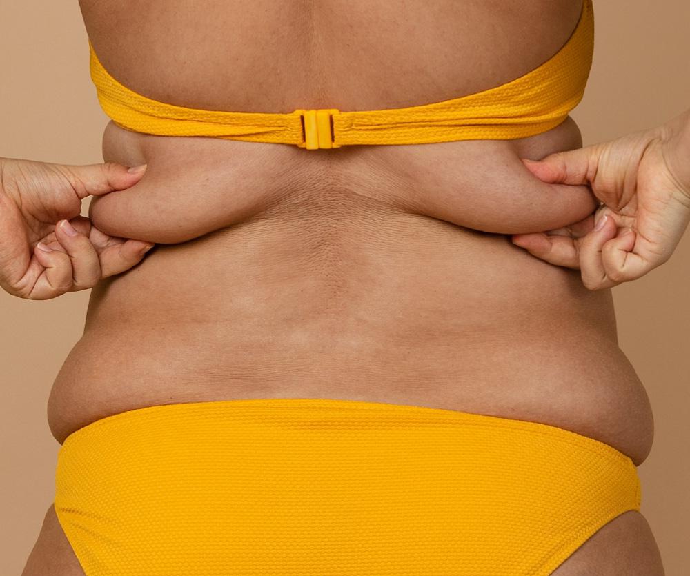 How much is excess skin removal surgery in the UK?