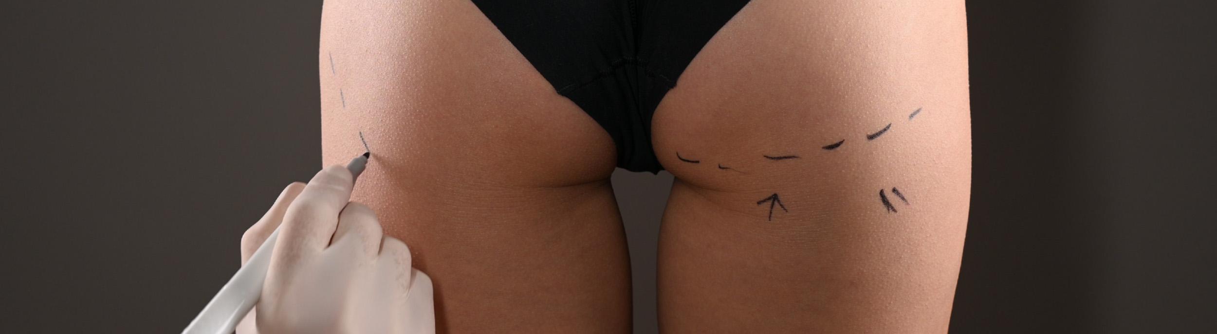 How long does a Brazilian Butt Lift last?