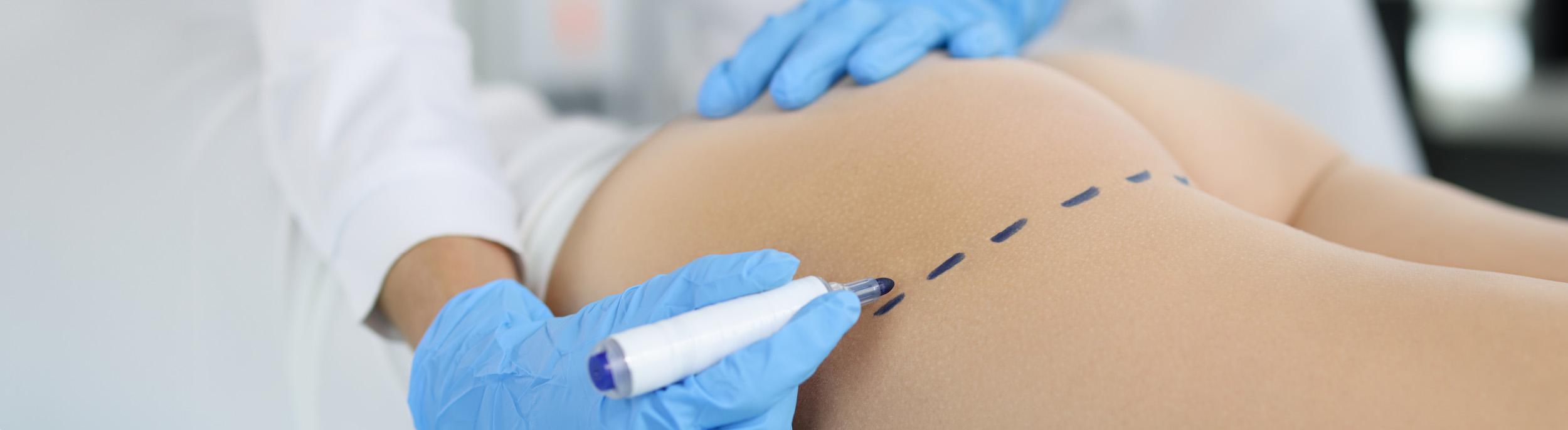 Brazilian Butt Lift risks