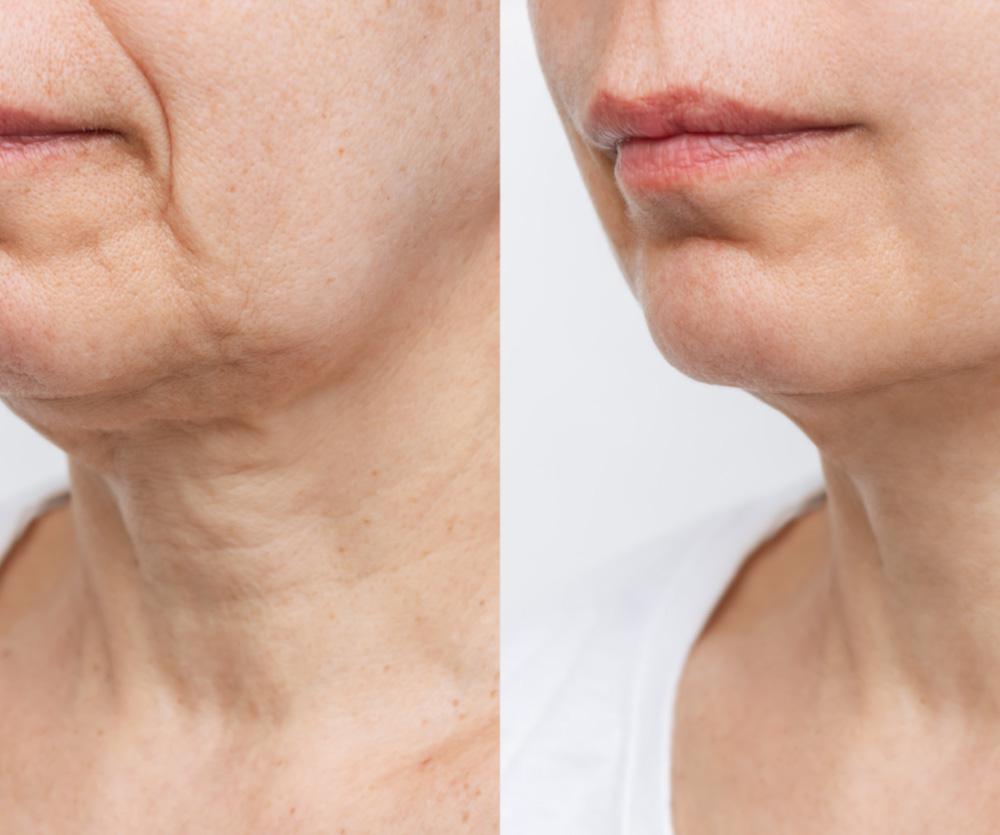 Neck lift before and after