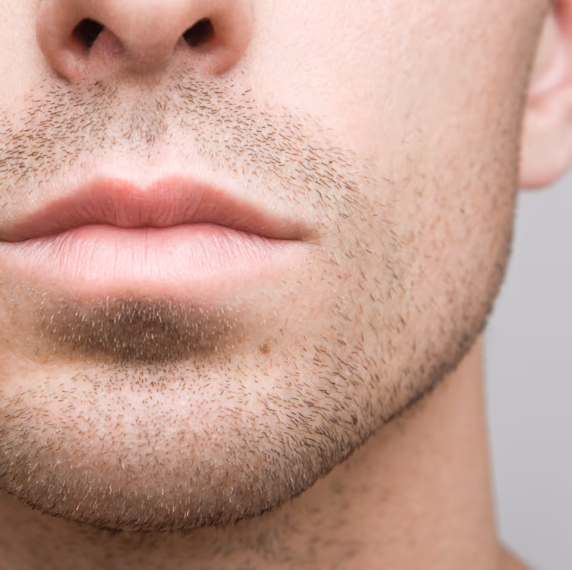 GENIOPLASTY