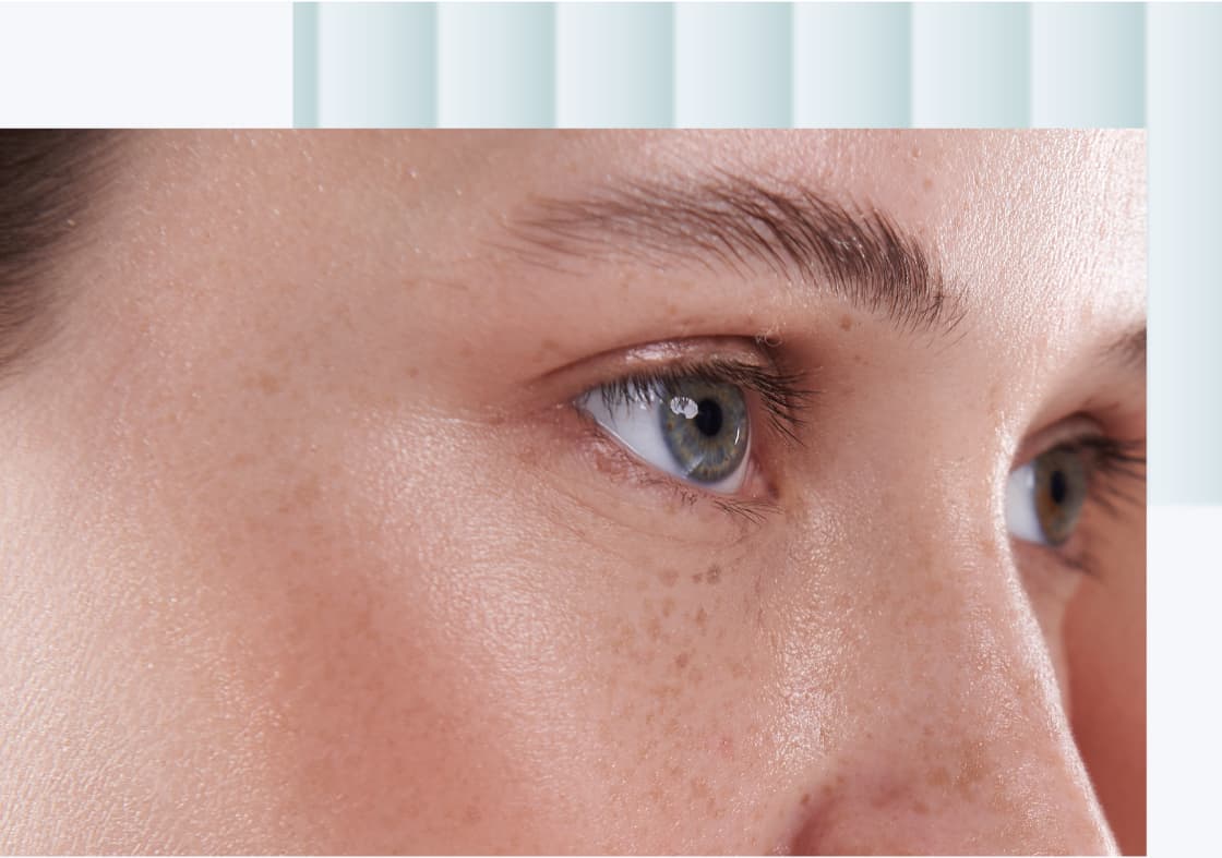 FÖRDELAR MED BOTOX