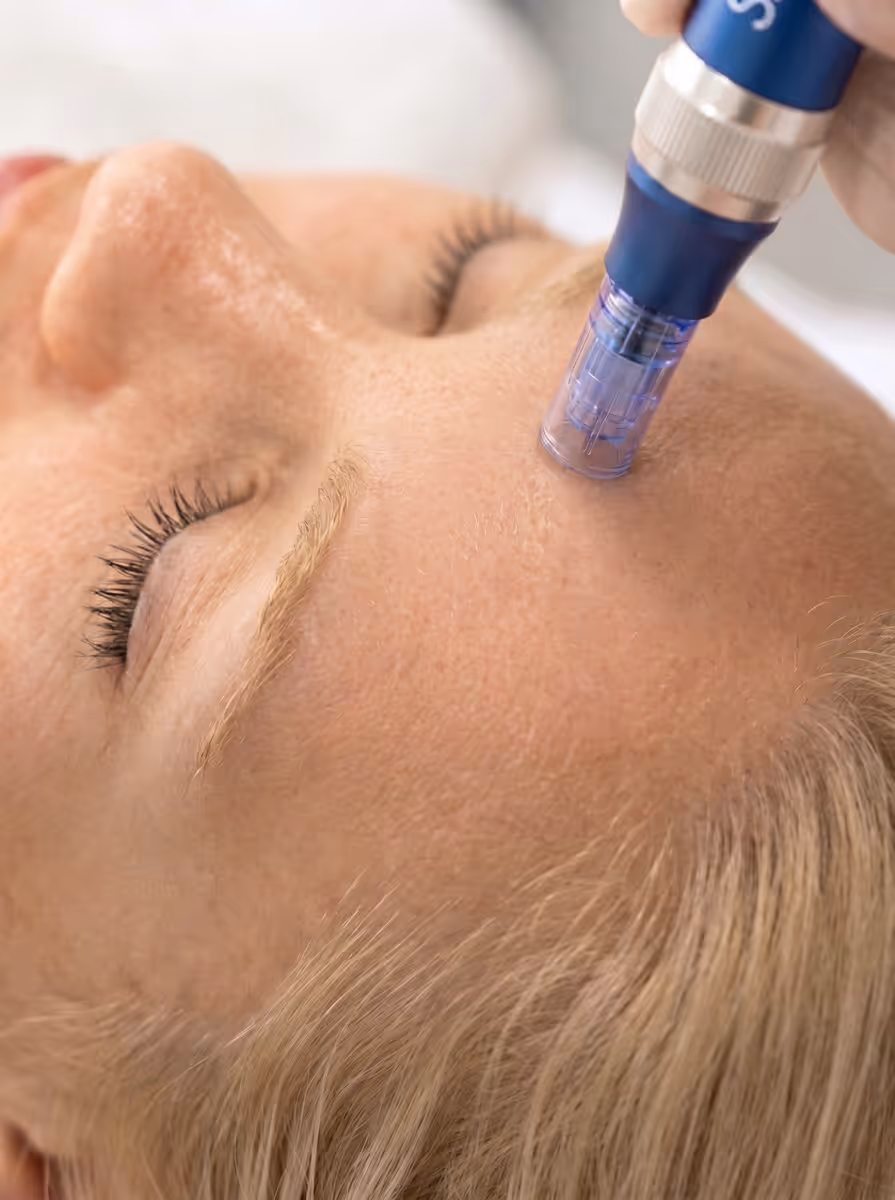 VAD ÄR MICRONEEDLING?