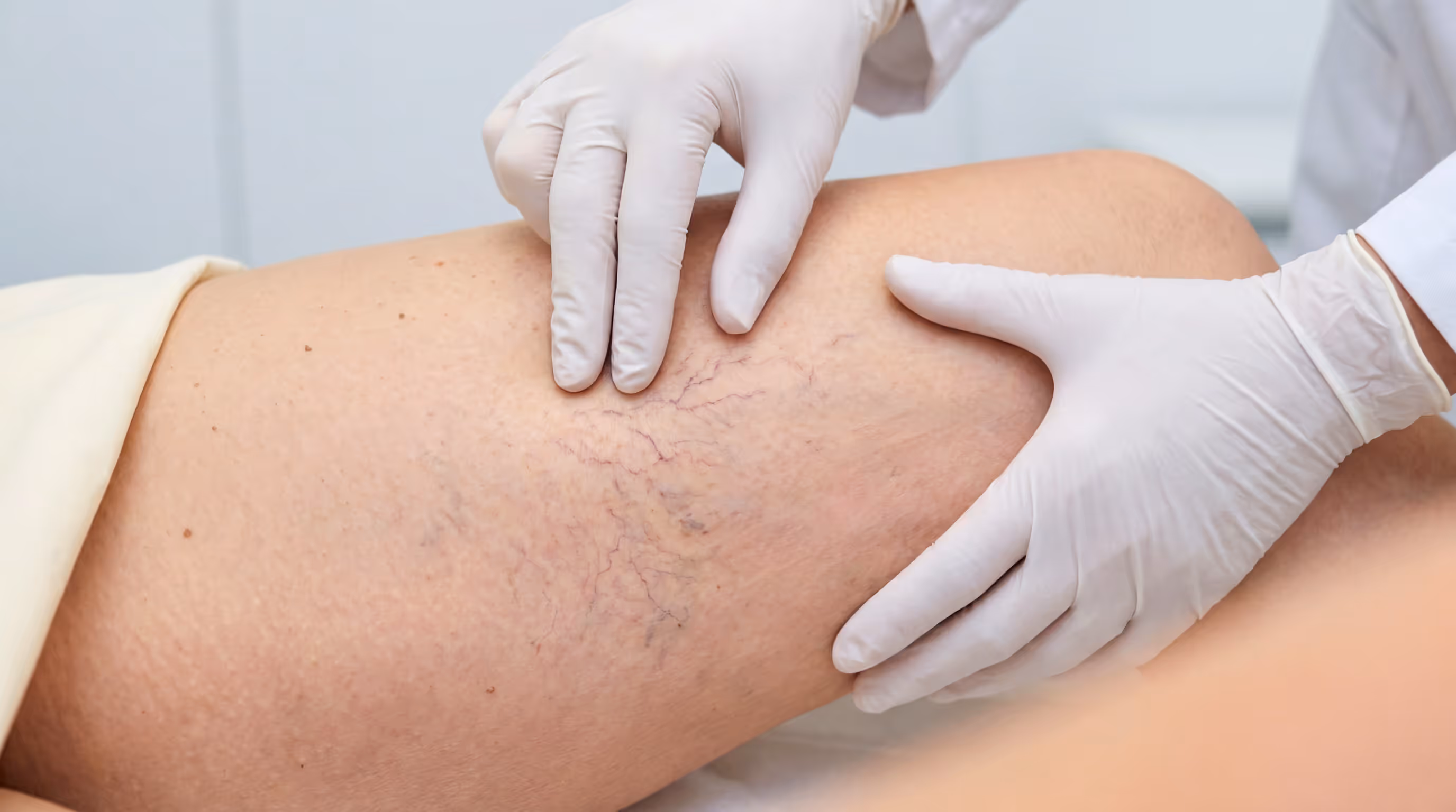 LASER MOT KÄRL OCH ROSACEA