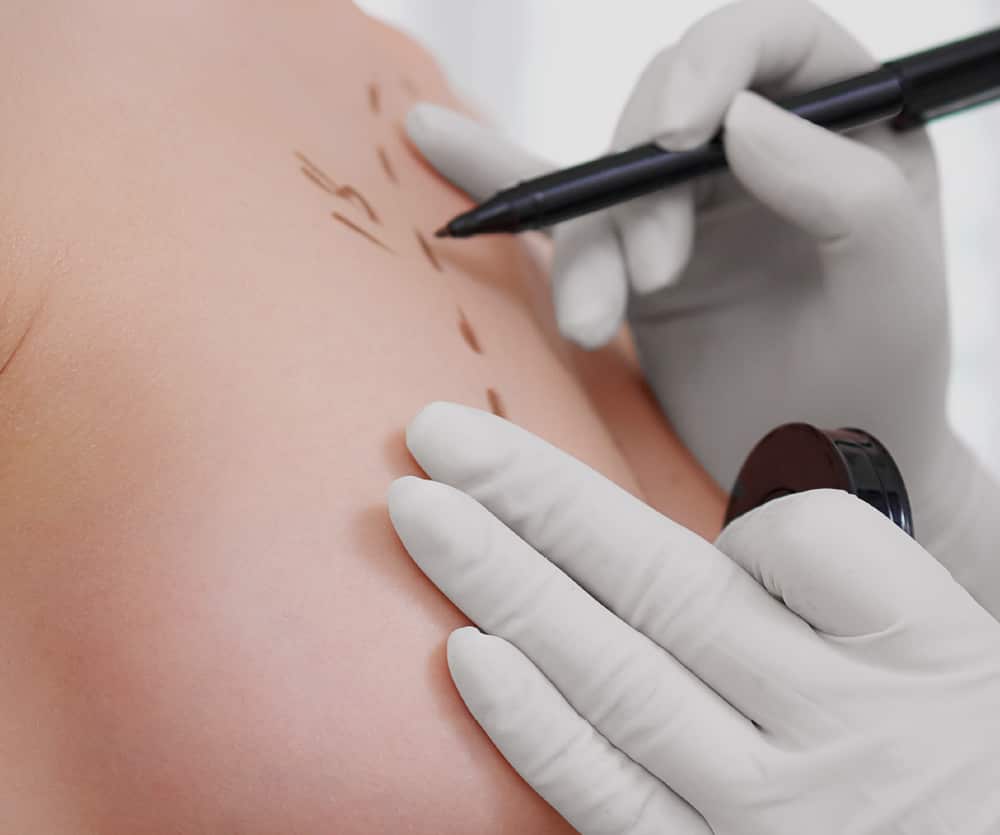 Breast Lift photo