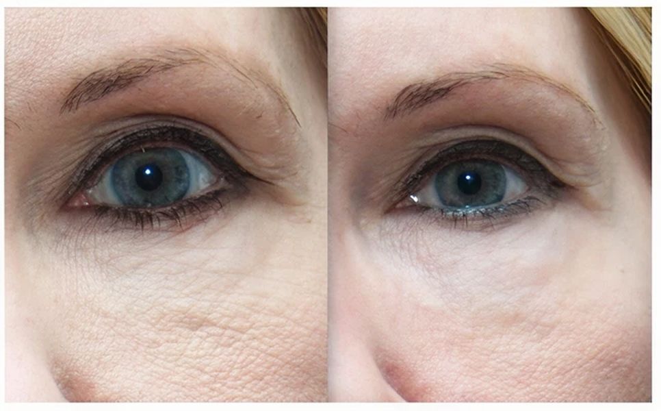 A close-up of two eyes, showing a comparison of skin texture and appearance around the eyelids. The left eye has noticeable wrinkles and fine lines, while the right eye appears smoother with reduced visible lines.