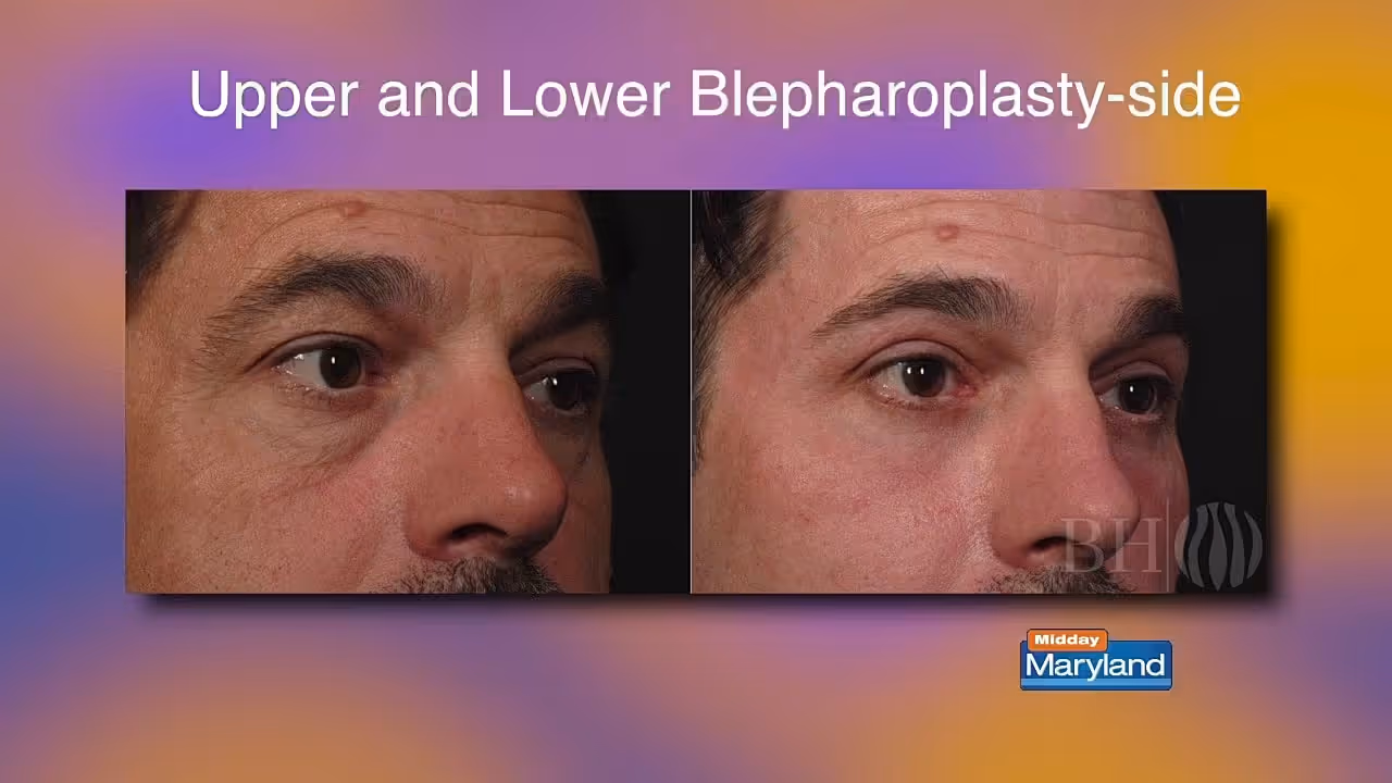 A side-by-side comparison of two male faces showing the results of upper and lower blepharoplasty. The left image displays a before scenario with noticeable eyelid sagging, while the right image shows a after surgery with a firmer eye appearance.