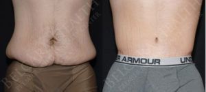 A comparison image showing two male torsos; the left side displays a torso with loose skin and abdominal fat, while the right side shows a toned abdomen with minimal fat. Both torsos are positioned side by side for direct visual comparison.