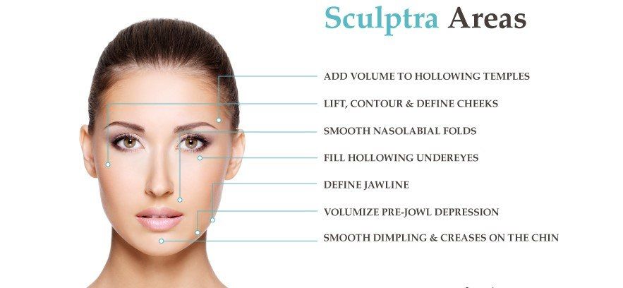 A woman with straight brown hair, looking directly at the camera, accompanied by text indicating various Sculptra treatment areas: 'Add volume to hollowing temples', 'Lift, contour & define cheeks', 'Smooth nasolabial folds', 'Fill hollowing undereyes'.