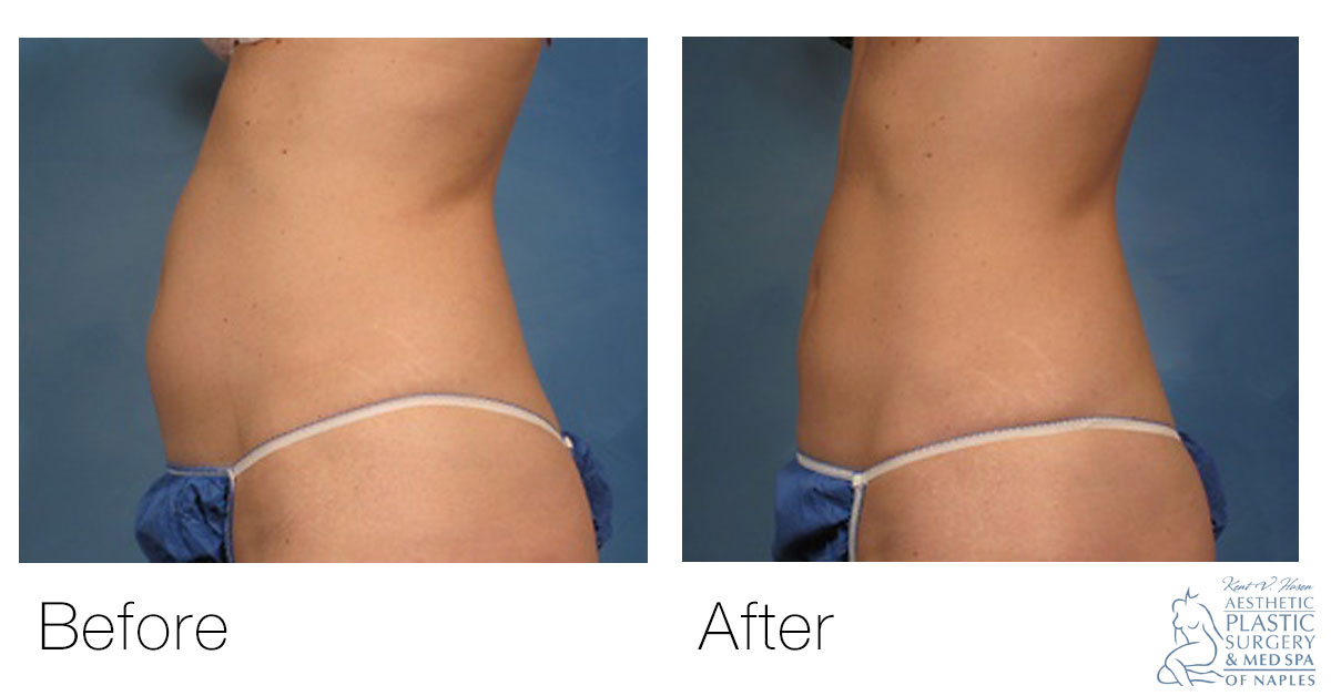 CoolSculpting before and after woman's abdomen side view