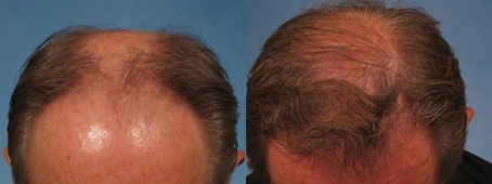 NeoGraft for hair restoration in Naples, FL