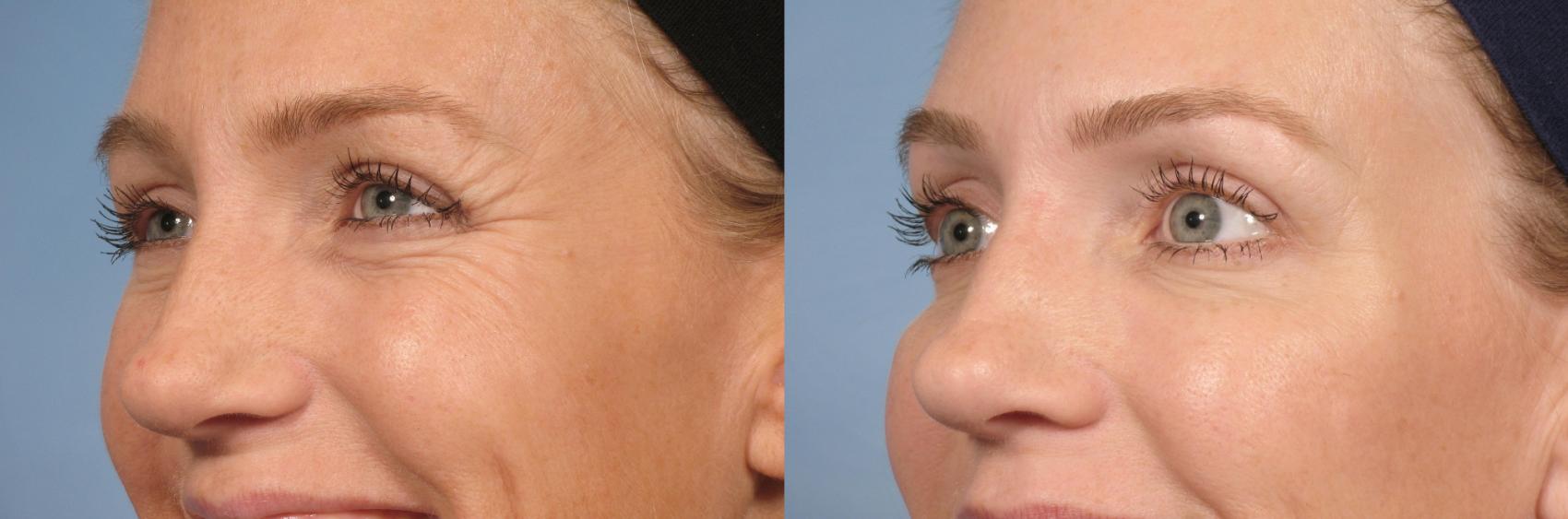BOTOX® Cosmetic before and after, case 20
