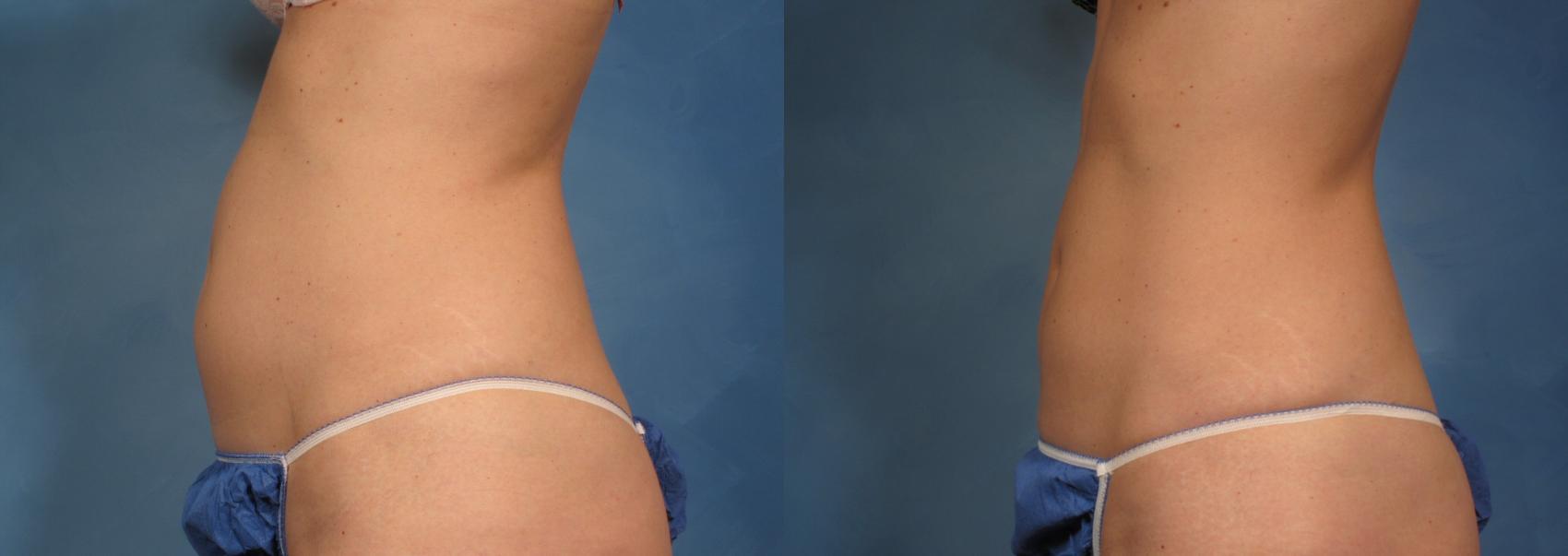CoolSculpting® Elite before and after, case 139