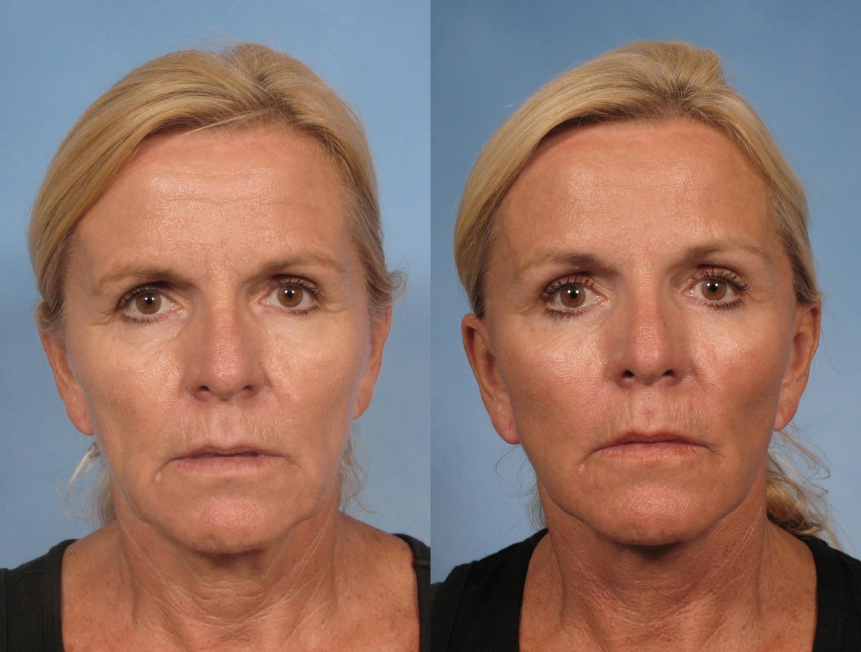 Eyelid Surgery before and after, case 106