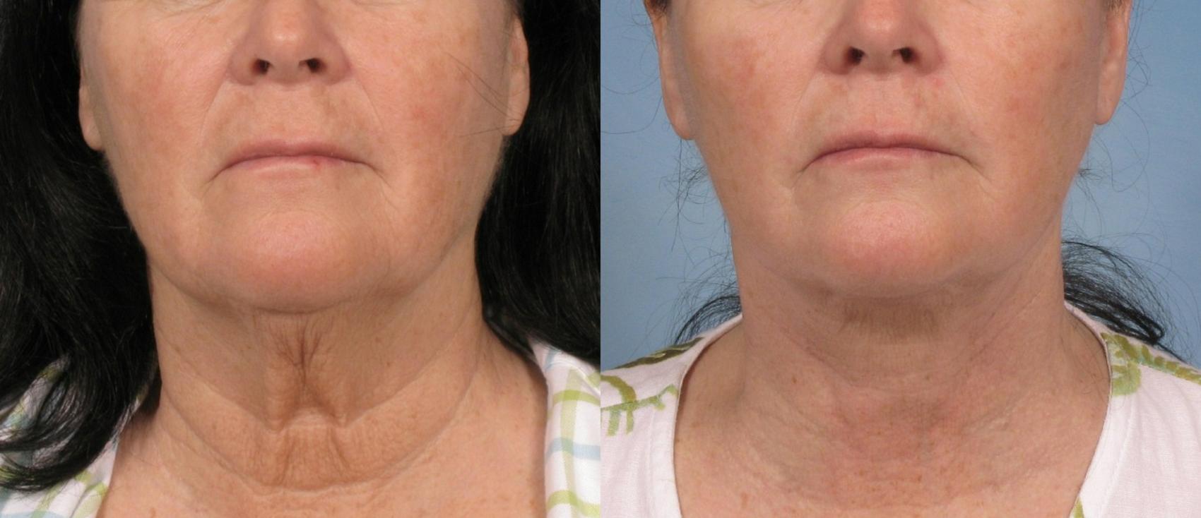 Facelift before and after, case 109