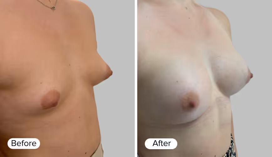 An image divided into two sections labeled 'Before' on the left and 'After' on the right. The left section shows a side view of a woman's chest before a procedure, while the right section displays the same view after the procedure, highlighting a fuller