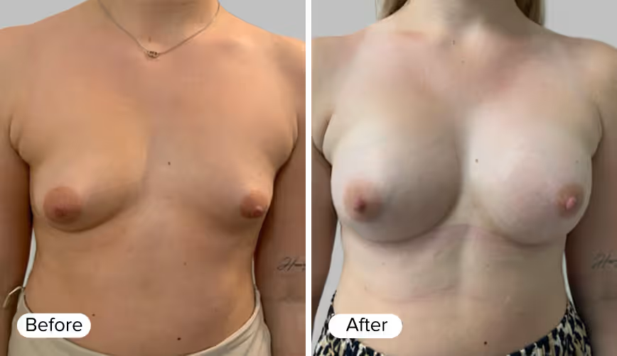 A side-by-side comparison image showing two female figures. The left side is labeled 'Before' and displays a natural appearance, while the right side is labeled 'After' and presents a modified aesthetic.