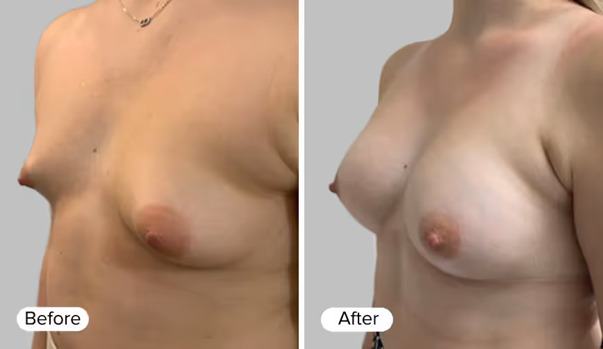 A side-by-side comparison image showing two female torsos labeled 'Before' on the left and 'After' on the right, illustrating changes in breast appearance after a procedure.