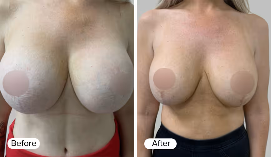 A side-by-side comparison of two images depicting the same female figure. The left image is labeled 'Before' and shows a less defined breast shape, while the right image is labeled 'After' and shows a fuller, more contoured breast shape. Both images