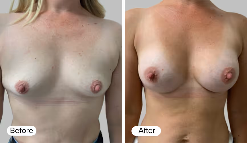A side-by-side comparison showing two images labeled 'Before' on the left and 'After' on the right, depicting the results of a cosmetic procedure. The image on the left features a person with lighter skin tone and visible markings, while the image on the