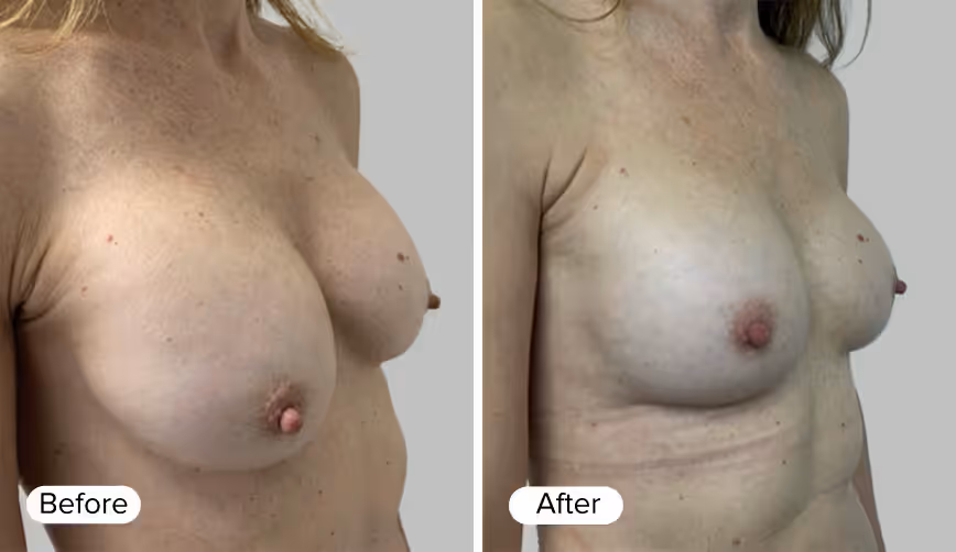 A side-by-side comparison of a woman's torso, labeled 'Before' on the left and 'After' on the right, showcasing changes in breast appearance.
