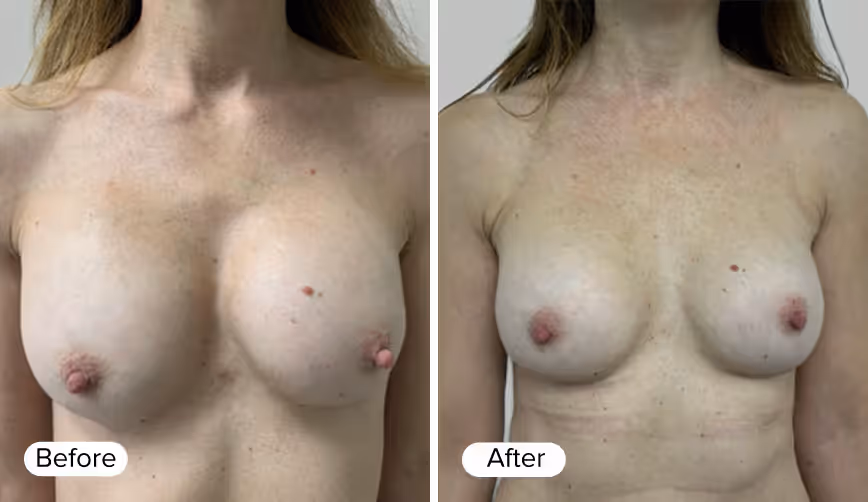 A side-by-side comparison of two images of a woman’s upper torso. The left image is labeled 'Before' and shows a fuller appearance, while the right image is labeled 'After' and displays a slimmer physique with more visible skin texture and slight scarring.