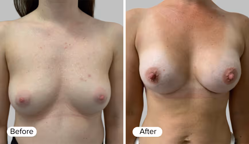 A 'Before' label on the left side and an 'After' label on the right side, each adjacent to images of a woman's upper body showing the differences in skin appearance and texture.