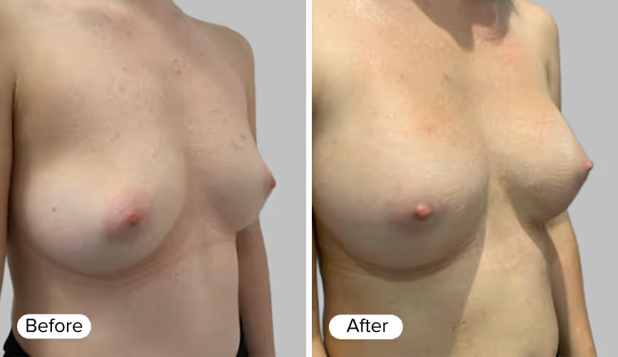 A side-by-side comparison of two images labeled 'Before' and 'After', showing changes in the appearance of the breasts.