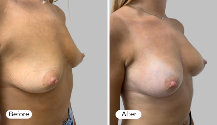 A side-by-side comparison image featuring two female torso images, labeled 'Before' on the left and 'After' on the right, showing the differences in appearance.