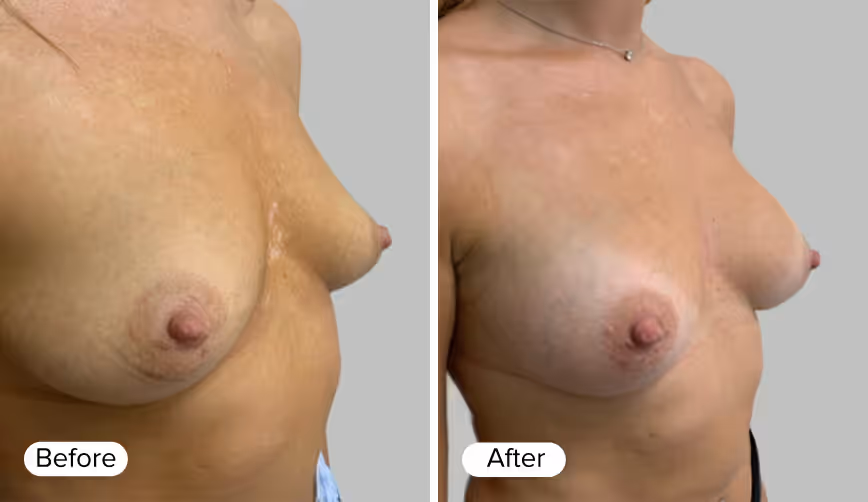 A side-by-side comparison of a woman's chest showing two images labeled 'Before' and 'After'. The 'Before' image displays natural breasts, while the 'After' image shows enhanced breasts.