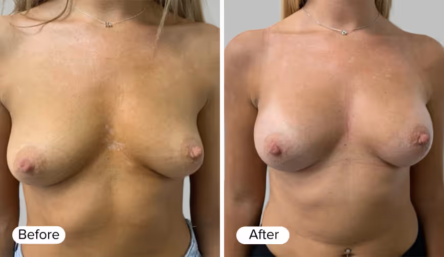 Before and After images showing a woman's torso, with the word 'Before' in light text on the left and 'After' in light text on the right.