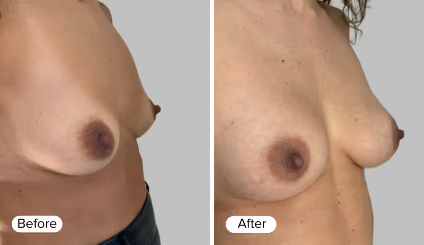 A side-by-side comparison image labeled 'Before' on the left and 'After' on the right, depicting breast enhancements. Both images show the profile of a woman's torso before and after a breast enhancement procedure.