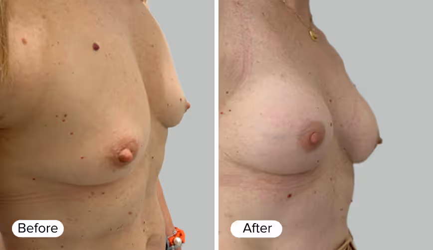 A side-by-side comparison image showing two female torsos labeled 'Before' on the left and 'After' on the right, illustrating a cosmetic procedure with differences in breast shape and appearance.