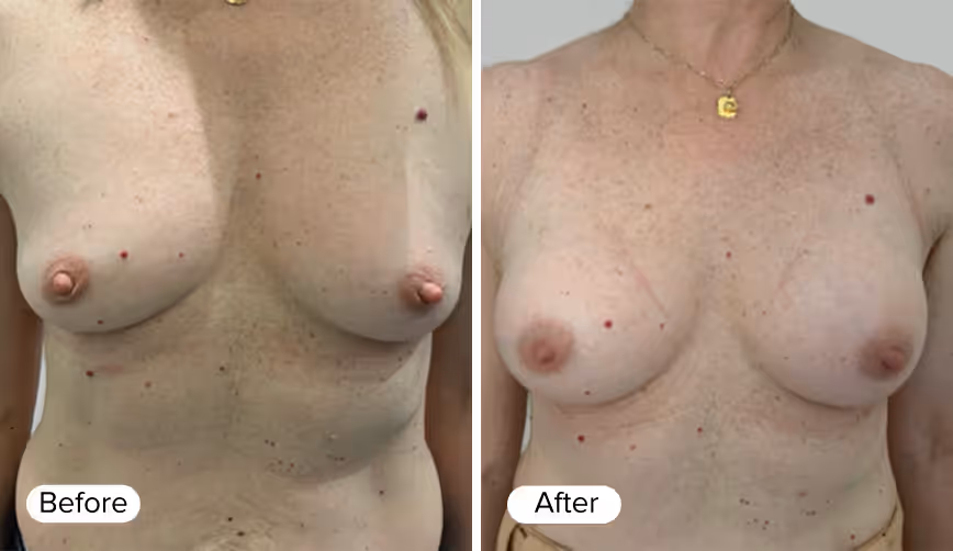 A side-by-side image showing two women's chests labeled 'Before' and 'After.' The 'Before' image shows a chest with uneven breast shapes and visible skin imperfections. The 'After' image displays a more symmetrical breast shape with smoother skin.