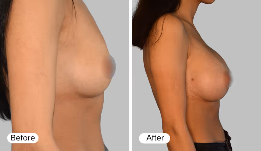 A side-by-side comparison image labeled 'Before' on the left and 'After' on the right, showing the profile views of a woman's torso before and after a breast enhancement procedure.