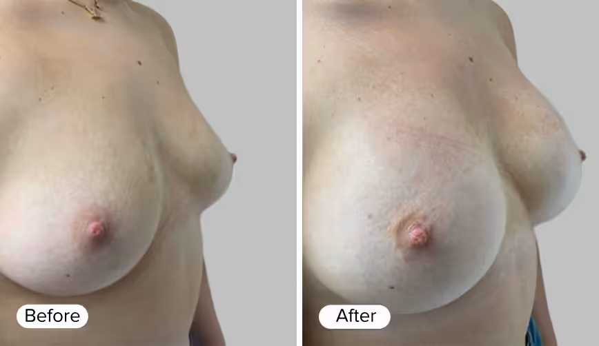 Before and after images showing the side profile of a woman's chest, with the text 'Before' in a white rounded rectangle below the left image and 'After' in a white rounded rectangle below the right image.