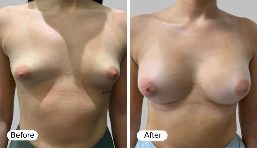 A side-by-side comparison image showing two female figures. The left side displays the 'Before' image, revealing a breast appearance with less volume. The right side shows the 'After' image, indicating fuller breasts with enhanced shape and contour.